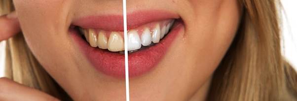 Dental Crowns: 7 Reasons Why You May Need One? Dental Crowns: 7 Reasons Why You May Need One?