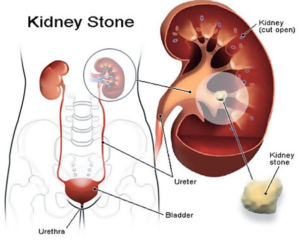 How To Cure Kidney Stones With Yoga? Symptoms, Treatment & Precautions