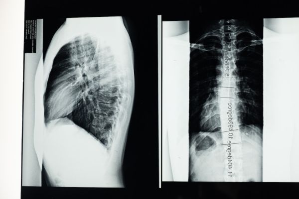 What Is Scoliosis and How to Treat It