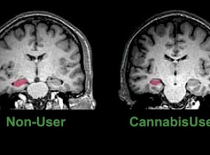 Marijuana's Long Term Effects On The Brain