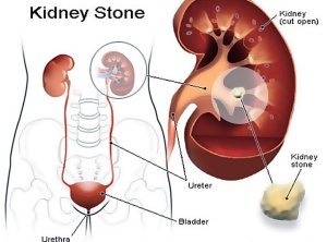 How To Cure Kidney Stones With Yoga? Symptoms, Treatment & Precautions