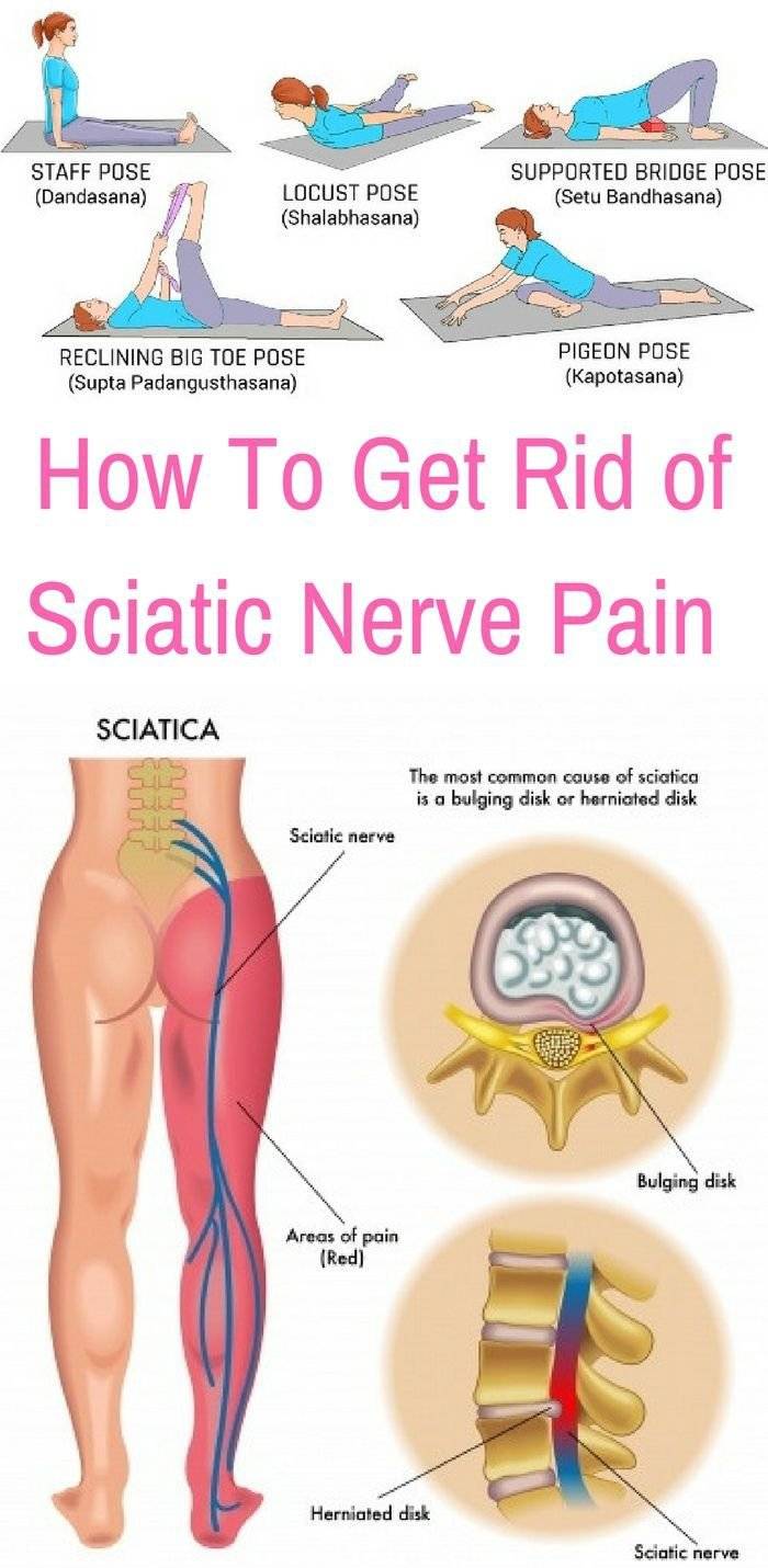 sciatica