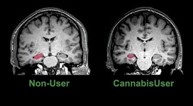 cannabis-brain
