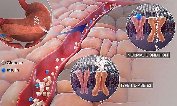 Might Heal Type 1 Diabetes Might Heal Type 1 Diabetes