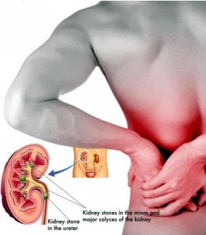 kidney_stone_remedies