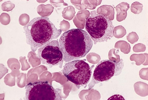 Acute myeloid leukemia