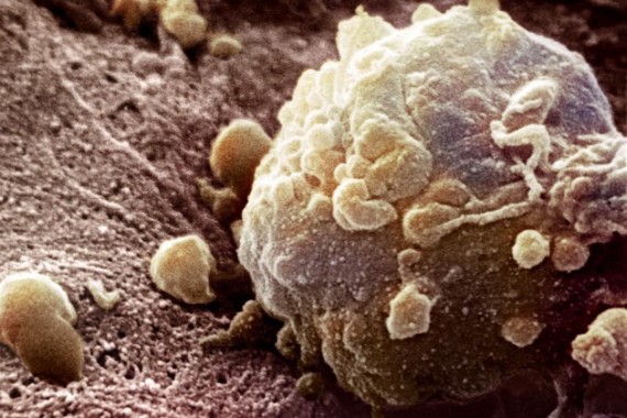 A melanoma cell A melanoma cell