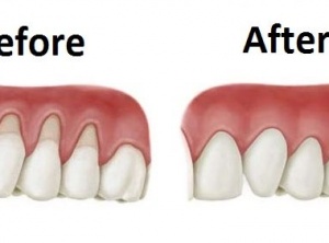 Grow Back Your Receding Gums In No Time With The Help Of These Natural Remedies
