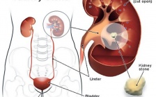 How To Cure Kidney Stones With Yoga? Symptoms, Treatment & Precautions